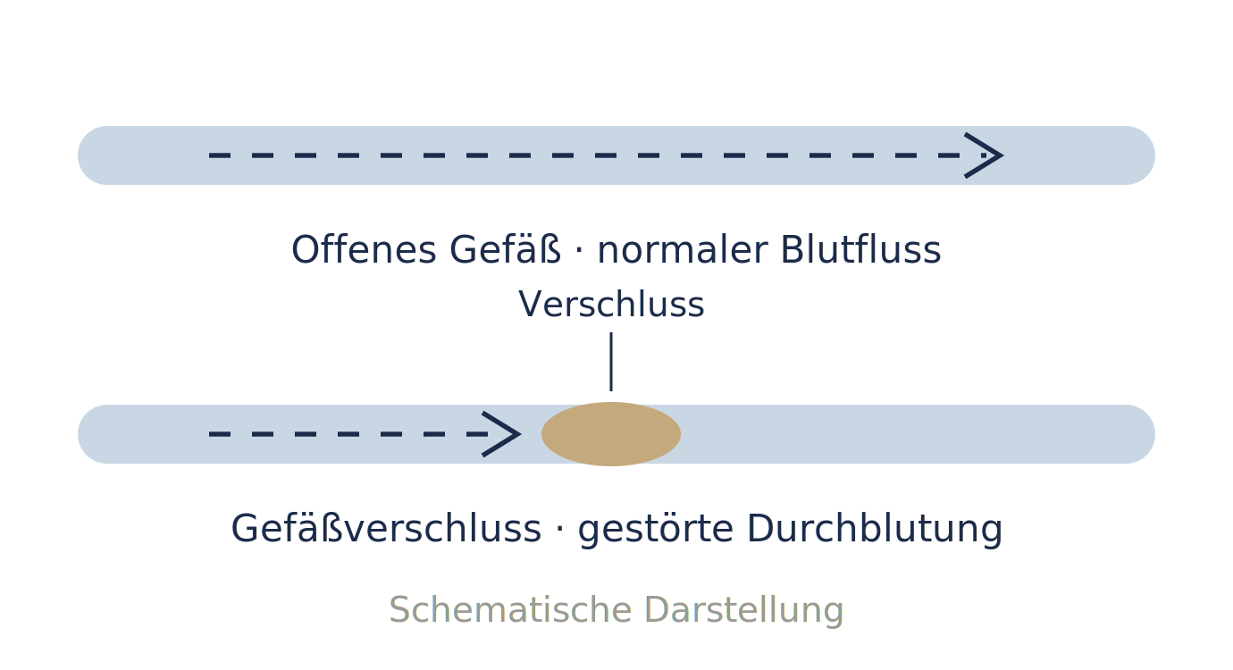 Netzhautgefäßverschluss Diagramm Netzhautgefäßverschluss Diagramm