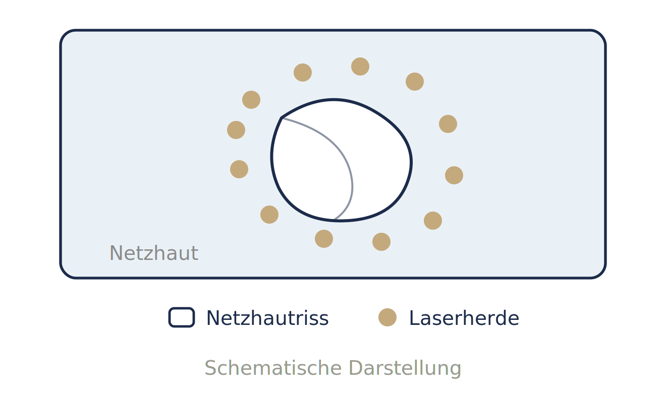 Netzhautriss Diagramm Netzhautriss Diagramm