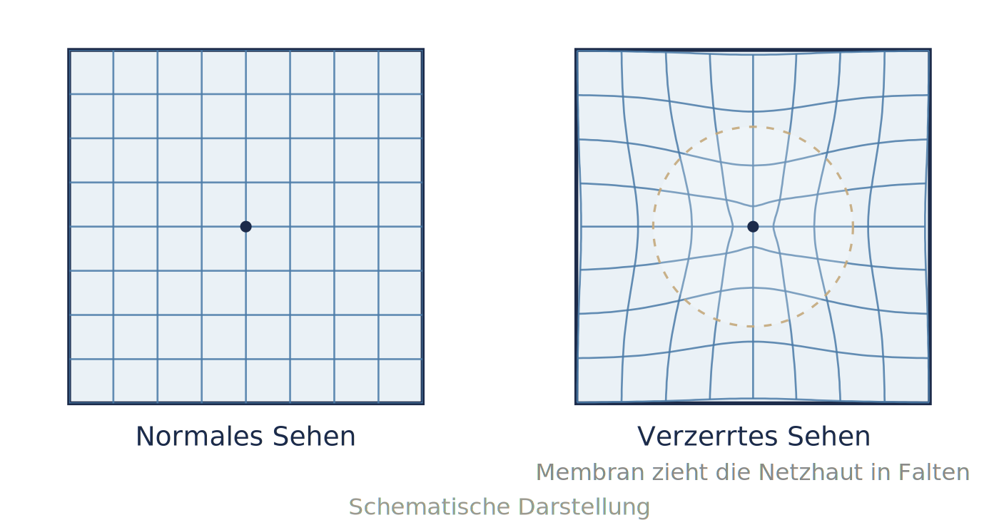 Epiretinale-Gliose_Diagramm